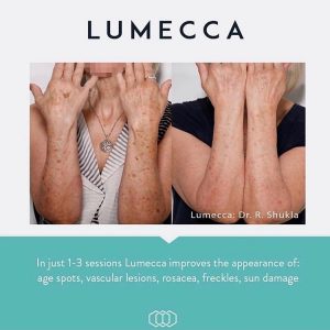 Lumecca skin rejuvenation before and after