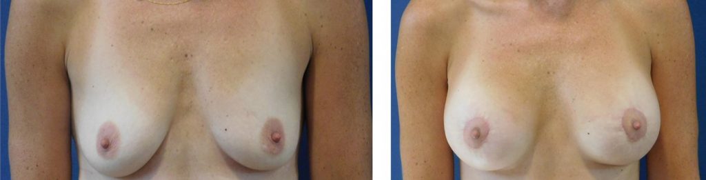 Breast augmentation with lift before and after