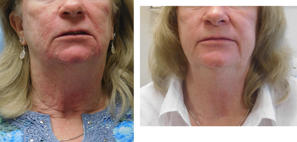 Fractora before and after