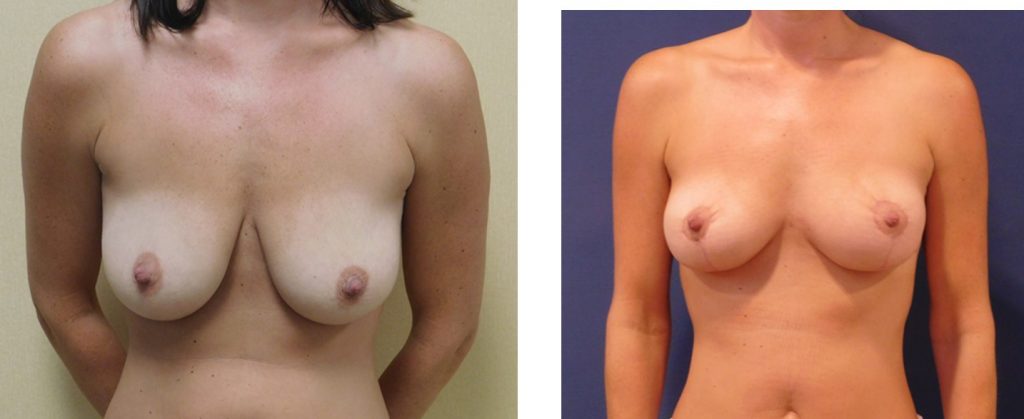 Breast Lift before and after