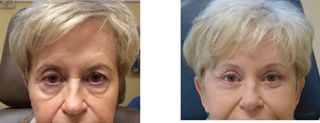 before and after upper eye lid brow lift